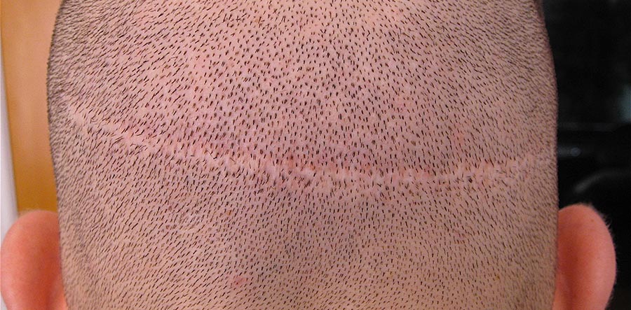 Pigmentation